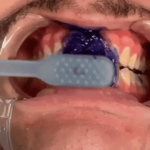 Mousse de blanchiment des dents Lanthome