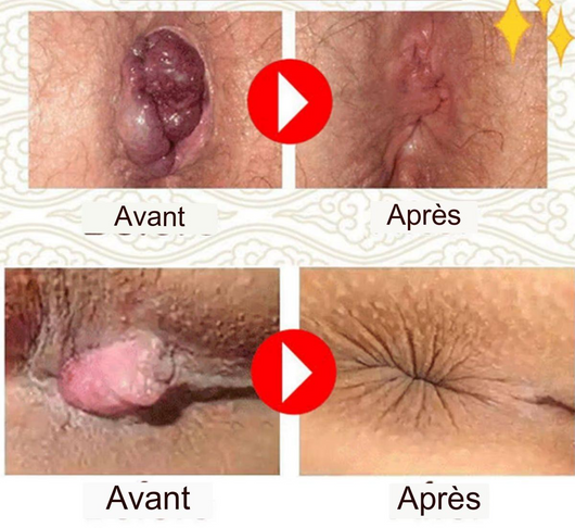 Thé  anti- hémorroïdes à base de plantes naturelle et super efficace